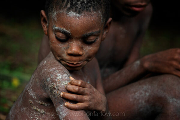 Pygmy Boy Examines Scarring after 5 Months of Whipping | Ituri Forest
From my journal:   We’ve come back to Salate for the end of the nKumbi.  I hear the music of beating sticks and chanting boys in the forest.  Tomorrow is their last day before being set free.  This is the only education they will get their entire lives.  This education is all about what leaves to pick for various tasks, what bark to peel, how to fish and hunt and survive in the woods.
They’ve been whipped every morning for five months. This morning the sole Bantu boy ran away because the men said that tomorrow—their last day—they would beat them severely.  The entire village looked for this boy and found him hiding late in the afternoon.  The chief was very upset, but not upset enough to stop the whipping the following day.
We went up to the nKumbi ground.  One group of boys is painted and sitting on their little circle of logs.  Another group of three are still painting each other… they are also singing—being led by the adults.  The adults are singing and twisting limbs to soften them and make them more effective whips—one boy on the bench is shaking so hard that he can barely sing—other boys are shaking, but not as hard.  Some of the other boys just seem resigned to their fate.  If they are shaking after five months of beating, I guess it really is going to be severe.
The first boy gets in position to be whipped.  They allow them to hold a log toward the whip to take the initial blow.  The Bantu chief, Potolico Putnam, whips the first three and the pygmy chief whips the next group. Each boy is whipped twice and then drops the log and marches away without tears.
The truth is these boys are just babies—they have little stick arms and distended stomachs.  But they have to be tough and they have to be tough early in life.  It’s a full time job just to eat.  All of these towns are hungry and have very little protein.  Even in Epulu at “Le Palais” I am eating mostly leaves (Sombe) and rice because the town is so hungry.  But, like I said, these boys are babies and they have to be hard to live in the forest most of the five months of this rite… Their little penises are cut and then covered with salt and then wrapped in leaves—and that’s the least of it.  If an adult snaps an order, they’ve been so well trained that they just run off in their little grass skirts and cut down piles of the sticks necessary to strip bark and make clothing or weave into cord or whatever task is important to the men at the moment. They do it without even speaking.  Often, not speaking is part of the deal—they have an apparatus that is sticks and a big leaf that they put in their mouth so they can’t talk.
